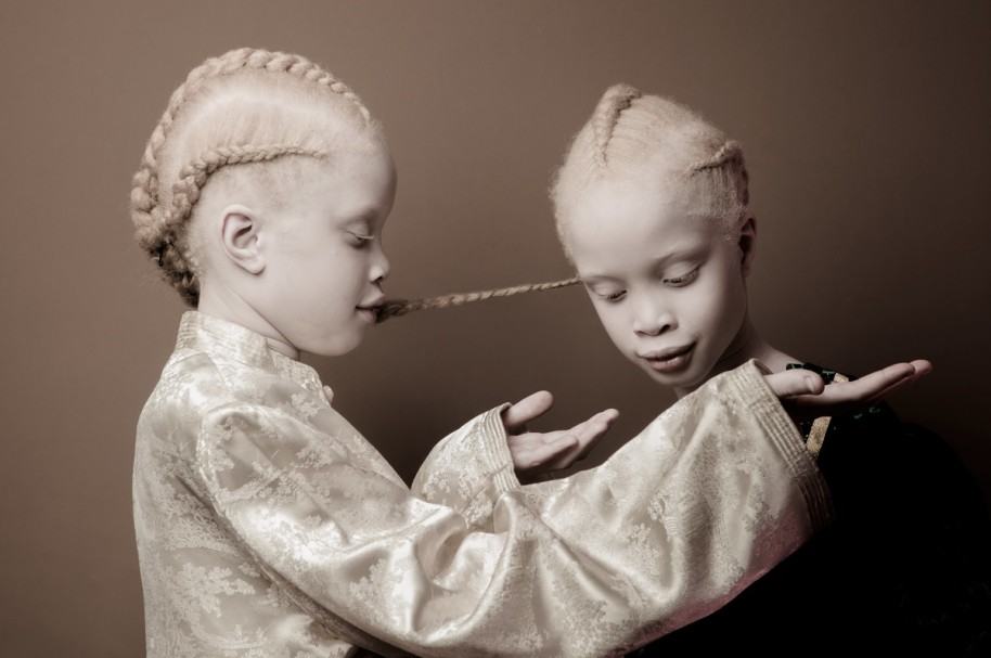 Gemelas albinas son famosas modelos